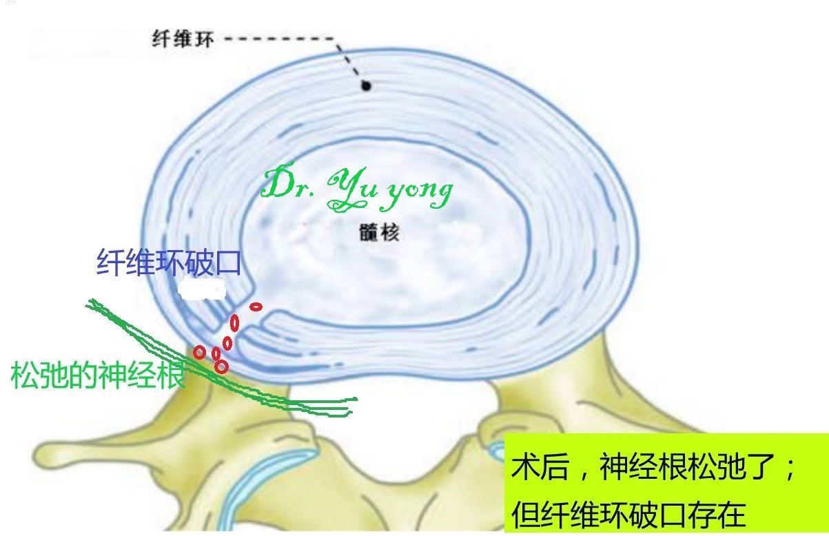 经皮穿刺内镜微创腰椎间盘手术后出现反跳痛是怎么回事? (转载)