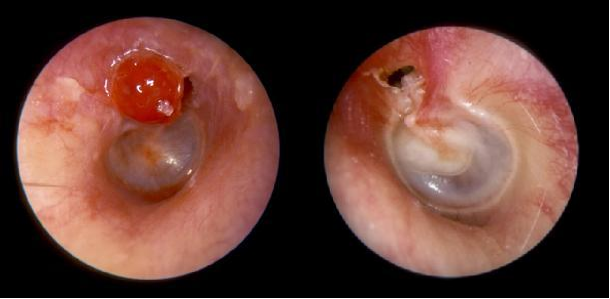 耳膜坏了什么症状 耳膜破了会有什么症状?