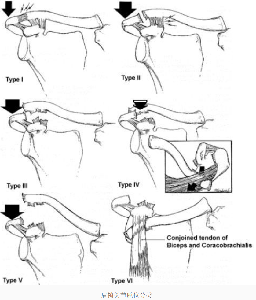 肩锁关节脱位 该如何治疗? 需要手术吗?_损伤