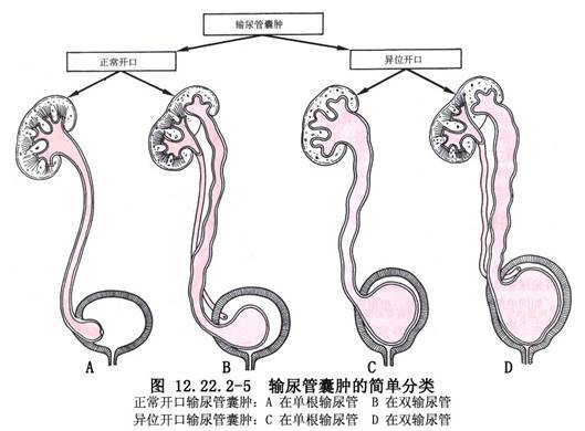 膀胱有囊肿怎么办