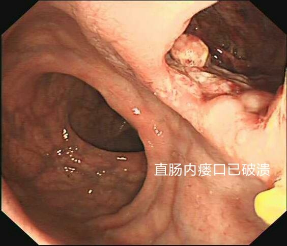 内镜下可见脓腔深达坐骨直肠窝,并于直肠形成内瘘