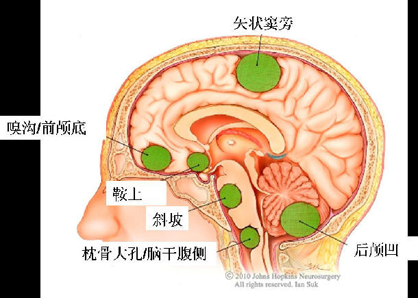 (参见我网站内文章:前的显微切除-无牵拉技术切除 岩斜坡及脑干腹