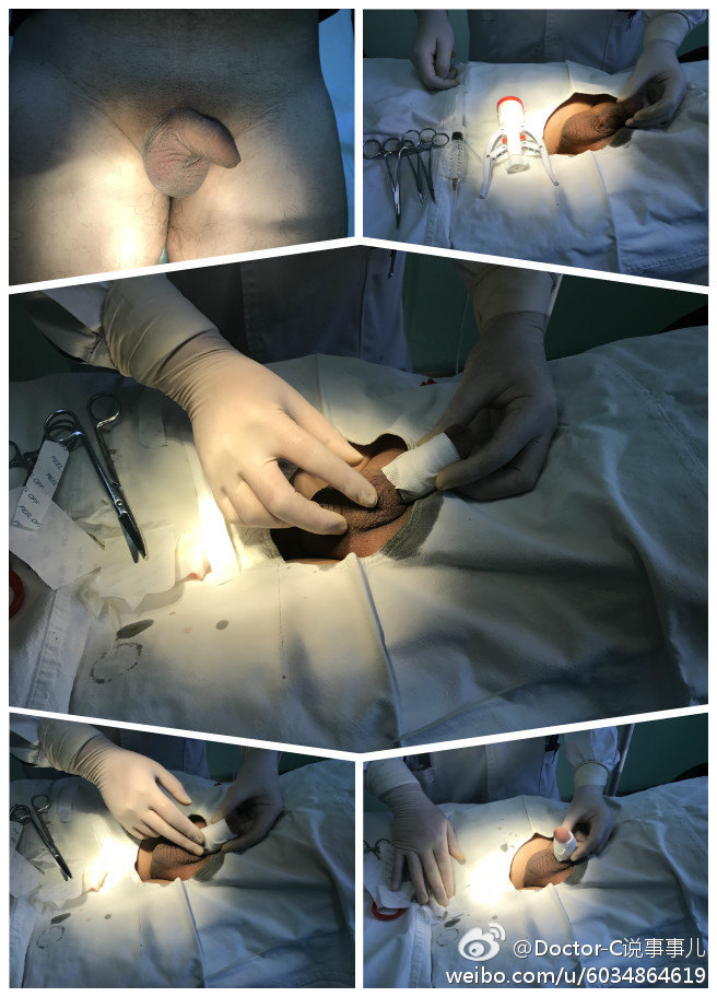 包皮环切掠影,可以帮助了解包皮环切术前与术后的状态