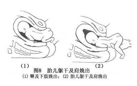 当b超单显示臀位,就一定要剖腹产吗?6周内调成头位,还可顺产