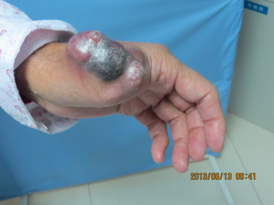 7月因"左手拇指指端黑色肿物1年"于当地医院切除后病检为"恶性黑色素