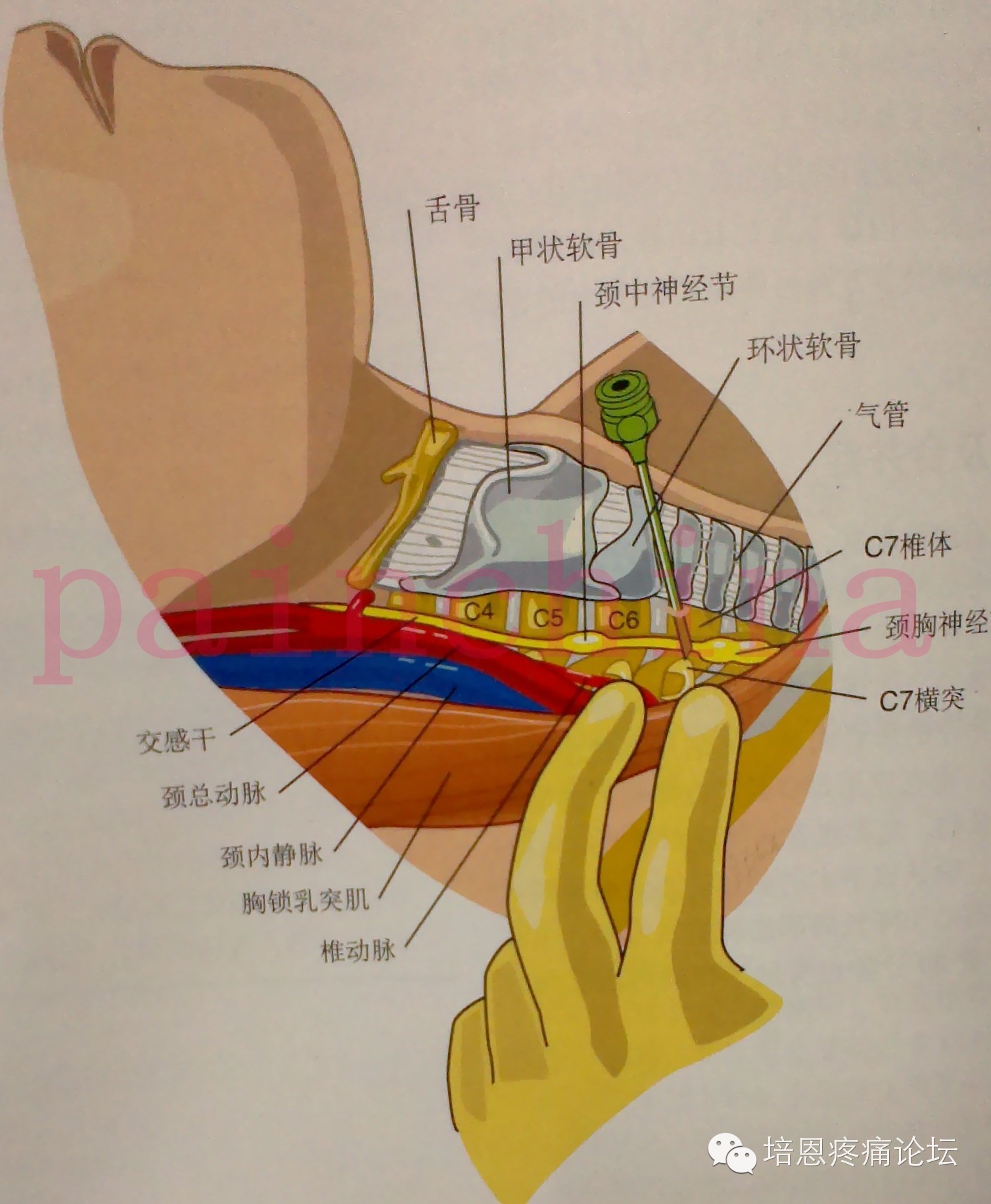 星状神经节阻滞治疗乳腺疾病的方法,具有解剖结构清楚,定位容易  定位