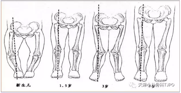 o型腿和x型腿都是异常的吗?