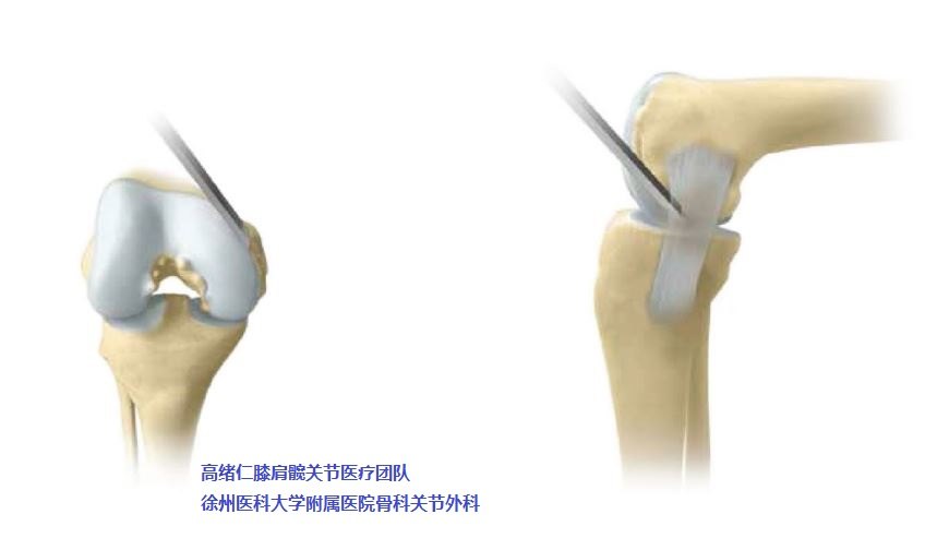 图解oxford牛津单髁膝关节置换手术过程18步