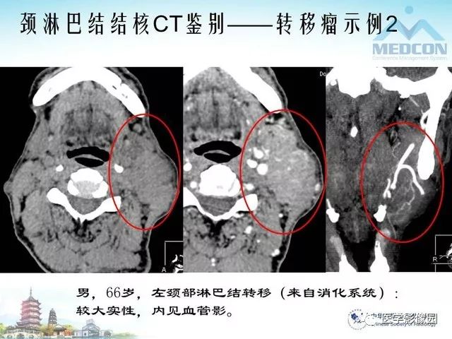 颈部淋巴结结核msct表现及鉴别影像天地