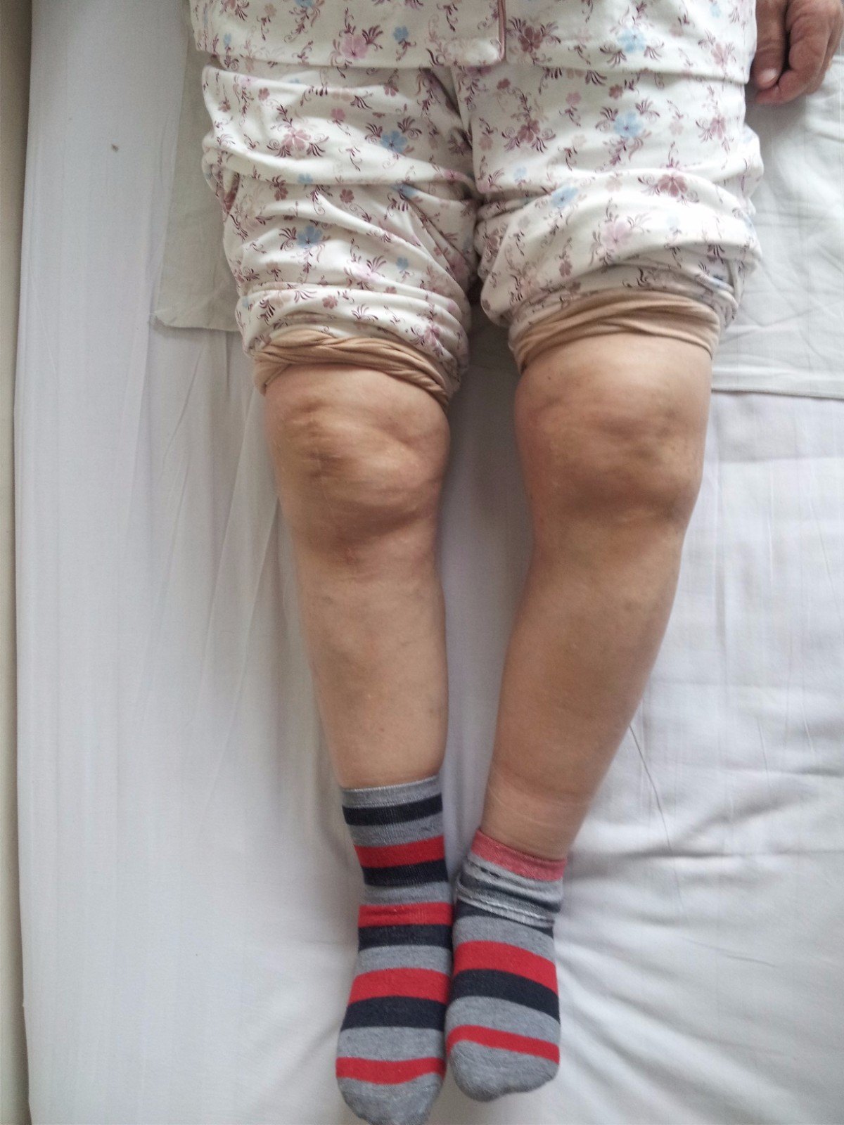 82岁的骨折病人 如何从双下肢无力到恢复行走功能？__中国医疗