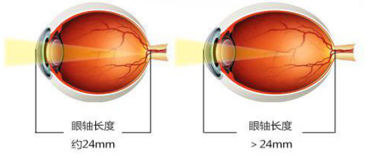 高度近视患者在门诊就诊时,我们建议检查:验光,眼压,lenstar(眼轴长度