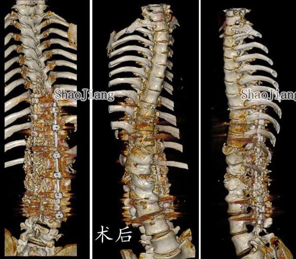 重度驼背(脊柱侧弯)患者术后亭亭玉立_手术