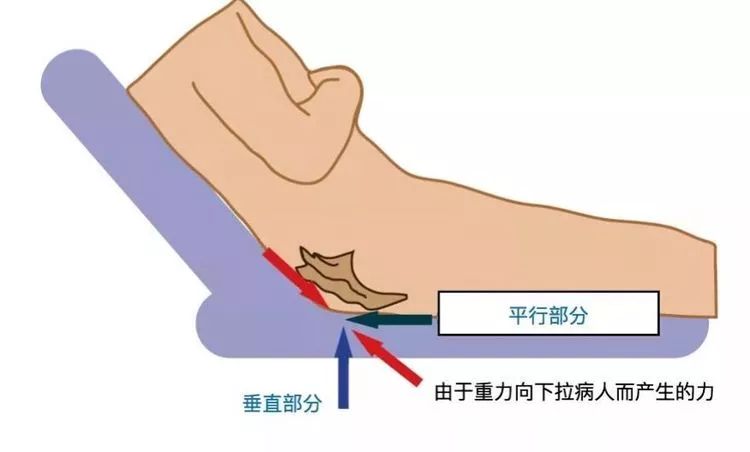 常见部位:仰卧位枕骨,肩胛部,肘部,脊椎体隆突处,骶部,足跟侧卧位耳部