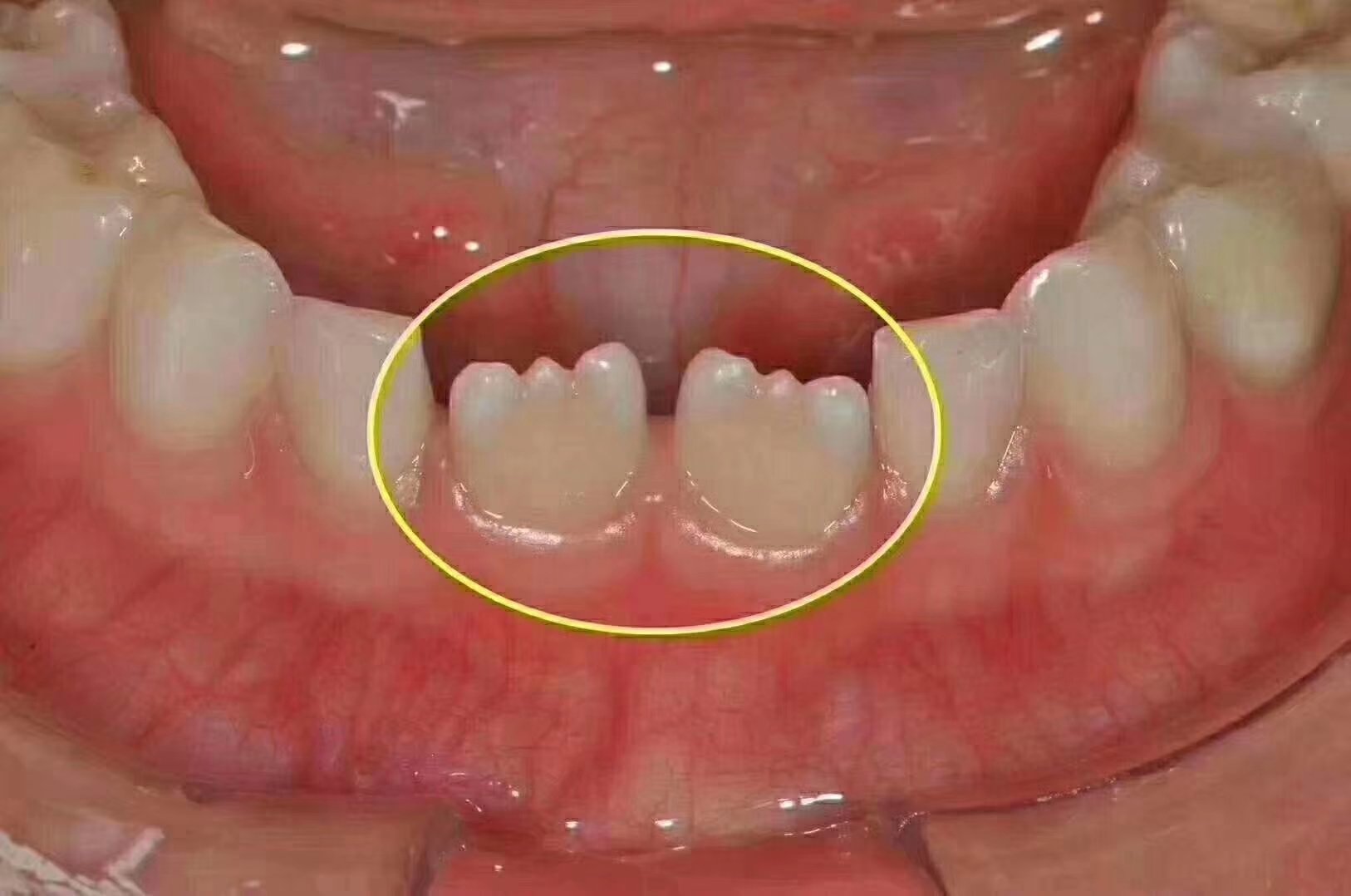 给大家科普一下:孩子替换恒牙时,上下门牙萌出时切端呈锯齿状,我们将