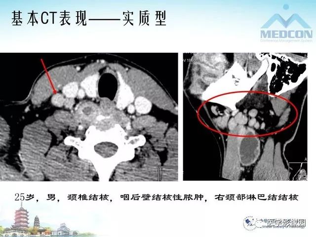 颈部淋巴结结核msct表现及鉴别影像天地