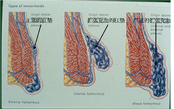 痔疮垫什么原理_轻微的痔疮长什么样子