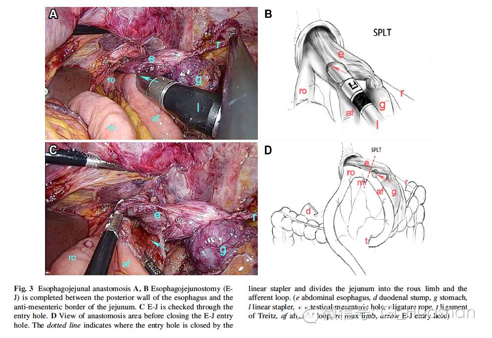 全腹腔镜全胃切除术后吻合新方式_食管空肠