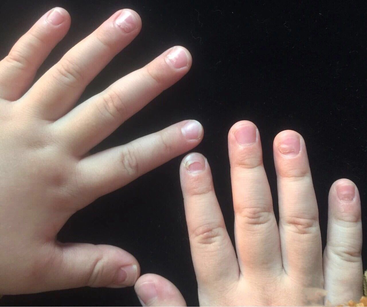 婴儿手指甲有白点（如果宝宝的指甲出现这些症状）-幼儿百科-魔术铺