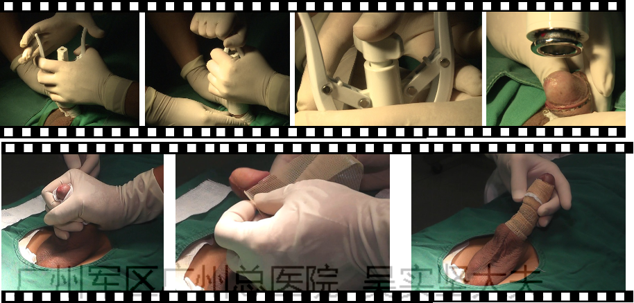 图解一次性包皮环切缝合器手术过程