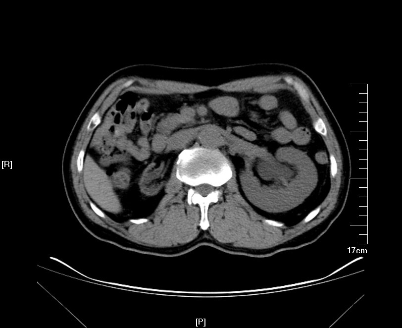ct检查提示:右肾萎缩无功能,左侧肾脏代偿性增大,左肾积水扩张,双侧输
