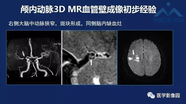 颅内动脉ct与mr血管结构成像和功能成像影像天地