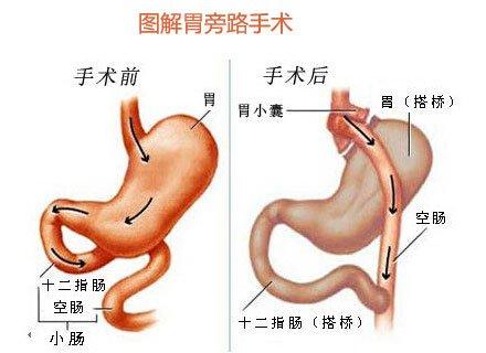 减肥手术多少钱_减肥手术哪种效果好_手术减肥