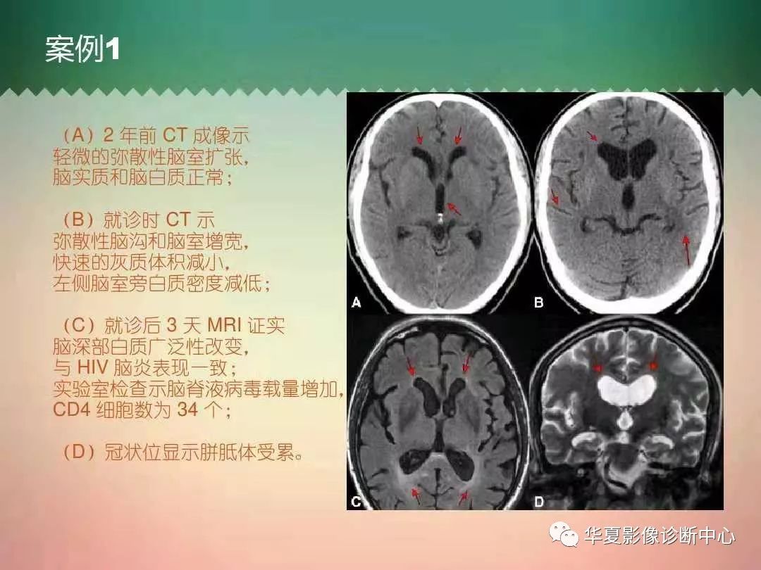 头颅ct七大陷阱,你可别中招