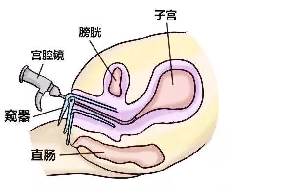 经血堵在子宫里出不来的月经量少,就需要宫颈手术来解决了