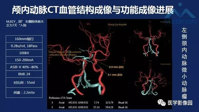 颅内动脉ct与mr血管结构成像和功能成像影像天地