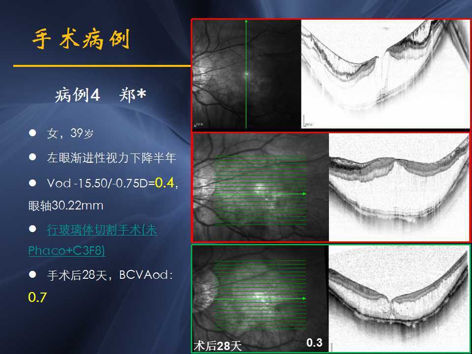 病例3:患者另外一只眼睛出现了黄斑裂孔性视网膜脱离,在上海某医院