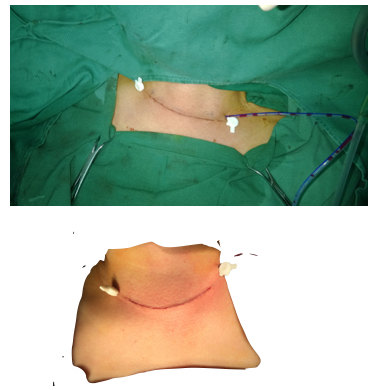 颈部甲状腺手术美容缝合