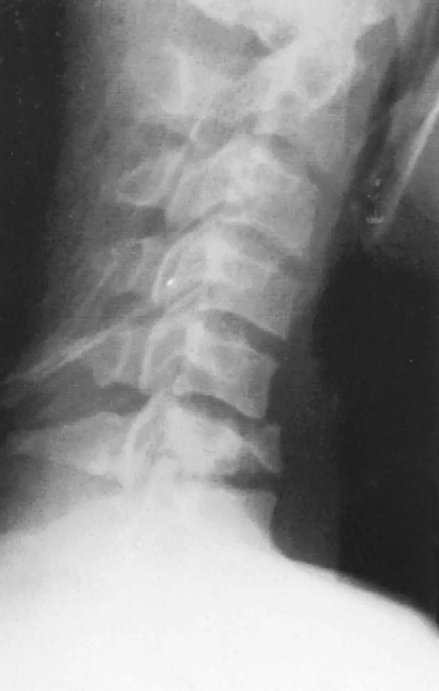 c6骨折:颈椎曲度反张,c6椎体楔形改变.