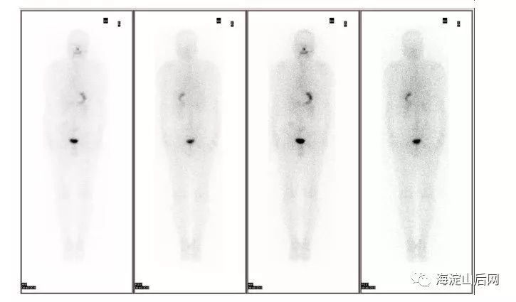 2018年5月 72小时全身显像如果患上甲状腺结节也不要过于担忧良性结节