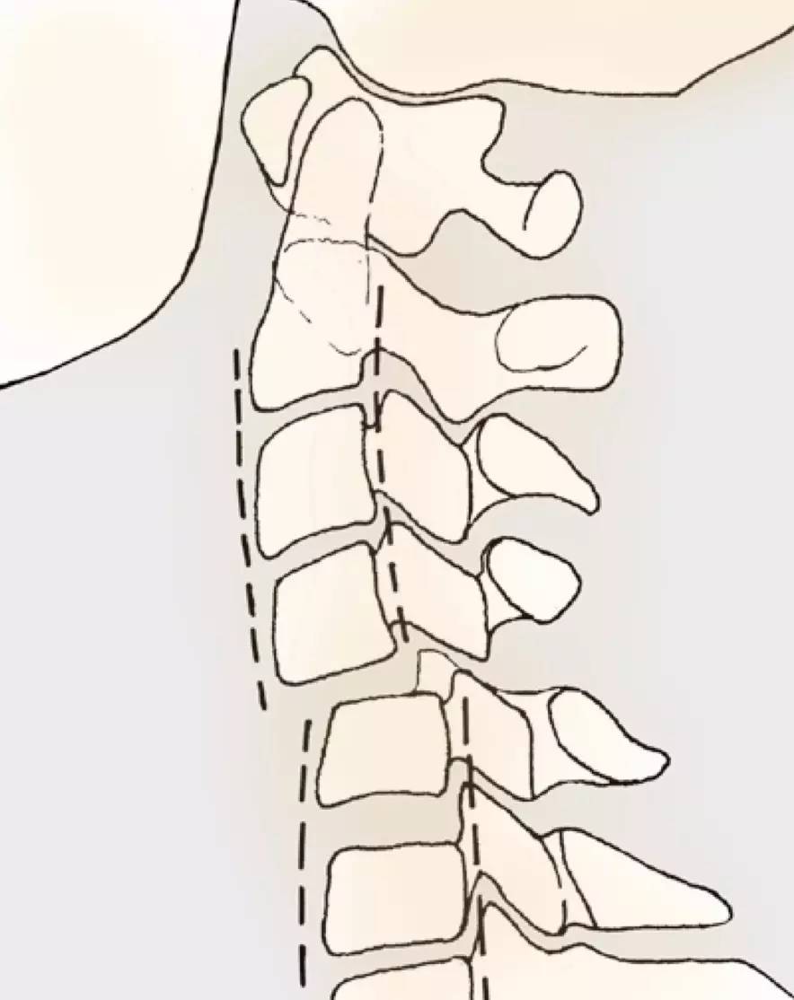 a 先天性椎体融合 b 椎体塌陷 a 骨赘或椎体前缘的骨折,见于颈部过伸