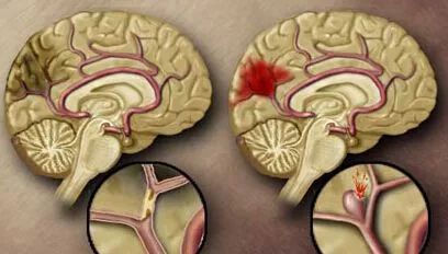 危害三:脑梗塞,脑萎缩  很多颈椎病患者因椎动脉痉挛,栓塞,而诱发为