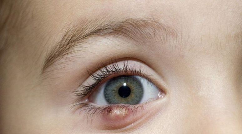 干货│同仁医院儿童眼科专家:儿童常见眼病及护理事项