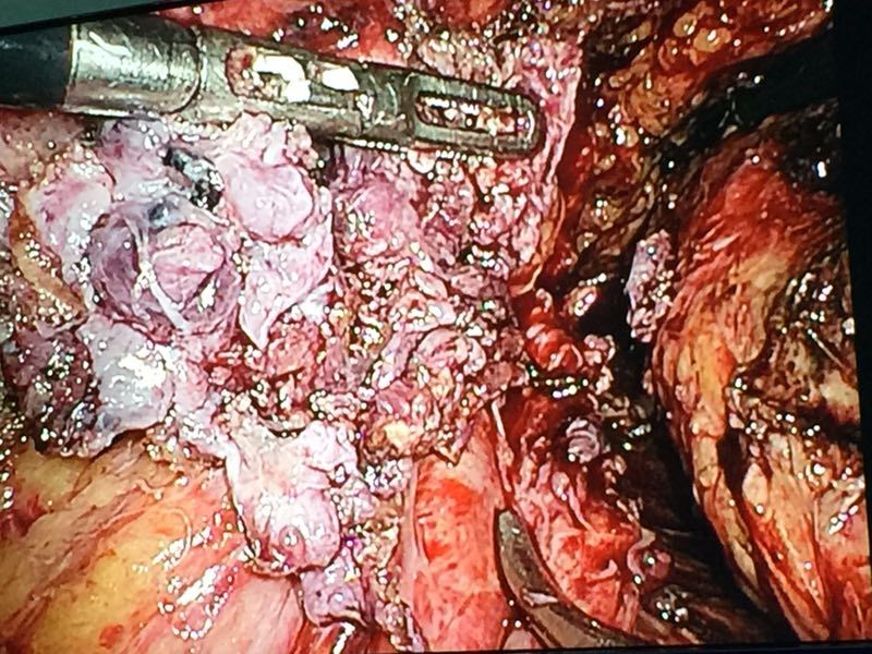 卵巢癌手术后一月腹腔镜后半盆腔脏器切除一例