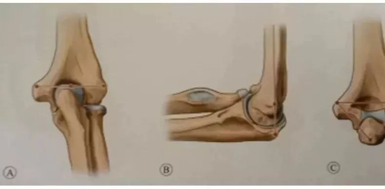参考意义:手术过程中应避免内固定物进入以上三个窝,以免影响肘关节屈