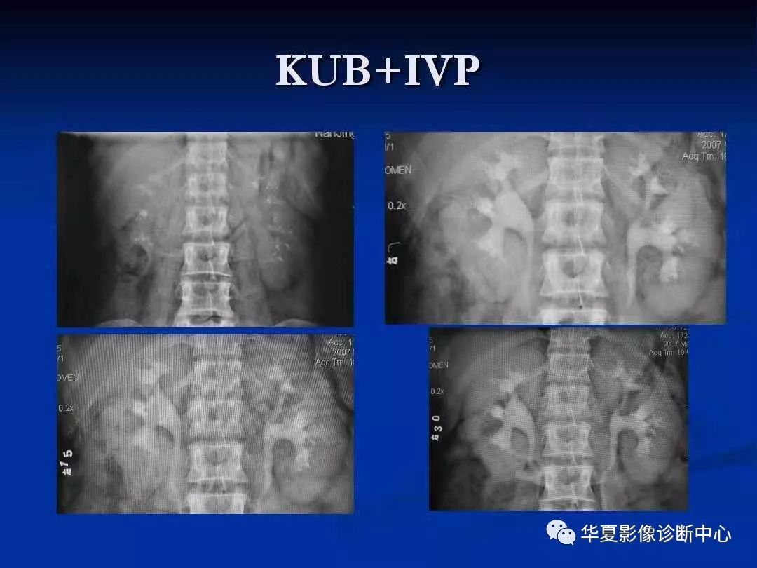 髓质海绵肾的影像诊断