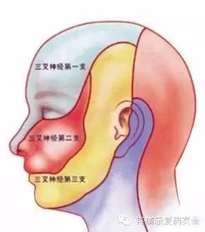 三叉神经半月节射频热凝术科普