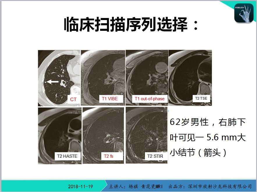 【11/21日直播课】杨祺:《磁共振肺部成像技术研究》