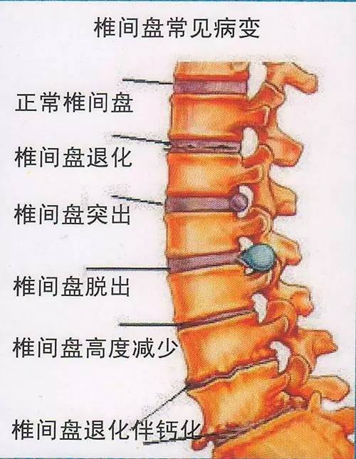 每天被腰椎间盘突出所折磨这一个体式帮你解决病痛