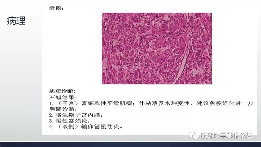 【每日一例| 720例】(子宫)富细胞性平滑肌瘤