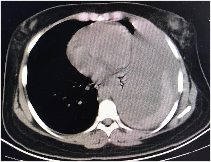 ct提示左侧大量血胸