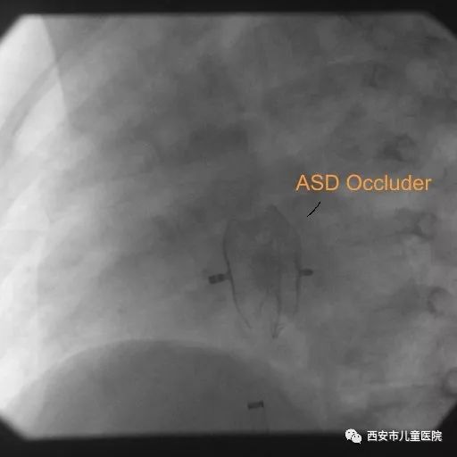 我院心血管内科成功完成一例边缘不良型房间隔缺损介入封堵手术