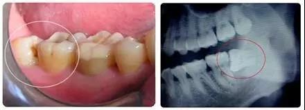 什么样的智齿要及时拔不得不自我检查一下