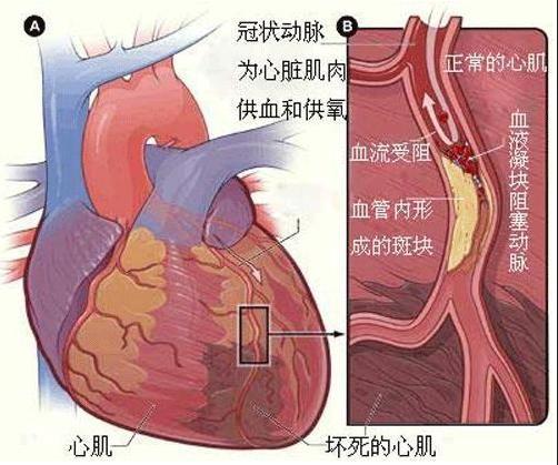 迅速将导管精准送达患者心脏回旋支