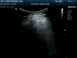 肺超声检查图像解读