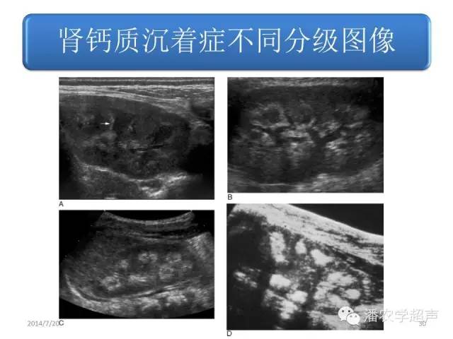 【超声微课堂】肾结石和肾钙质沉着症超声表现的异同之二