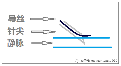 1,第一种情况:针尖部分进入静脉,导丝置入困难.